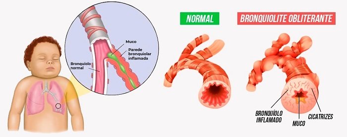 32ab1680 bronquiolite 1