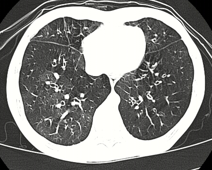 Scanner thoracique d’un enfant atteint de bronchiolite oblitérante post-infectieuse, avec zones sombres d’air piégé